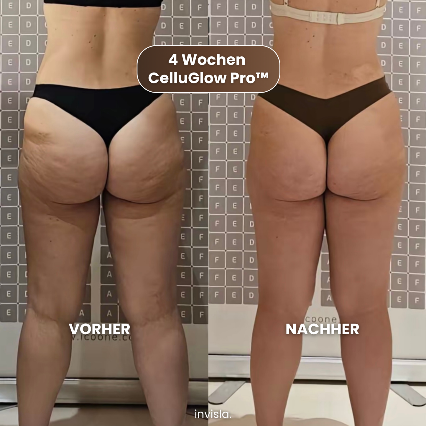 CelluGlow Pro™ Anti-Cellulite Massagegerät mit Wärme & Vakuum