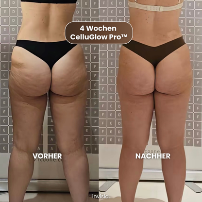 CelluGlow Pro™ Anti-Cellulite Massagegerät mit Wärme & Vakuum