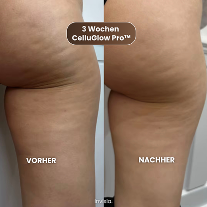 CelluGlow Pro™ Anti-Cellulite Massagegerät mit Wärme & Vakuum