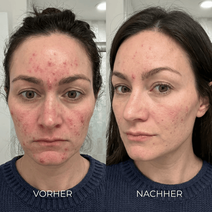 LUMERA 2. Gen. LED Infrarotlicht Maske - invisla